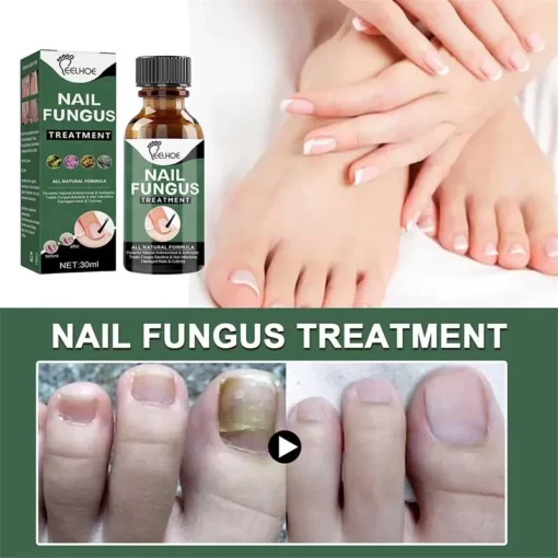 Anti-Funguses Nail Treatment - Image 3