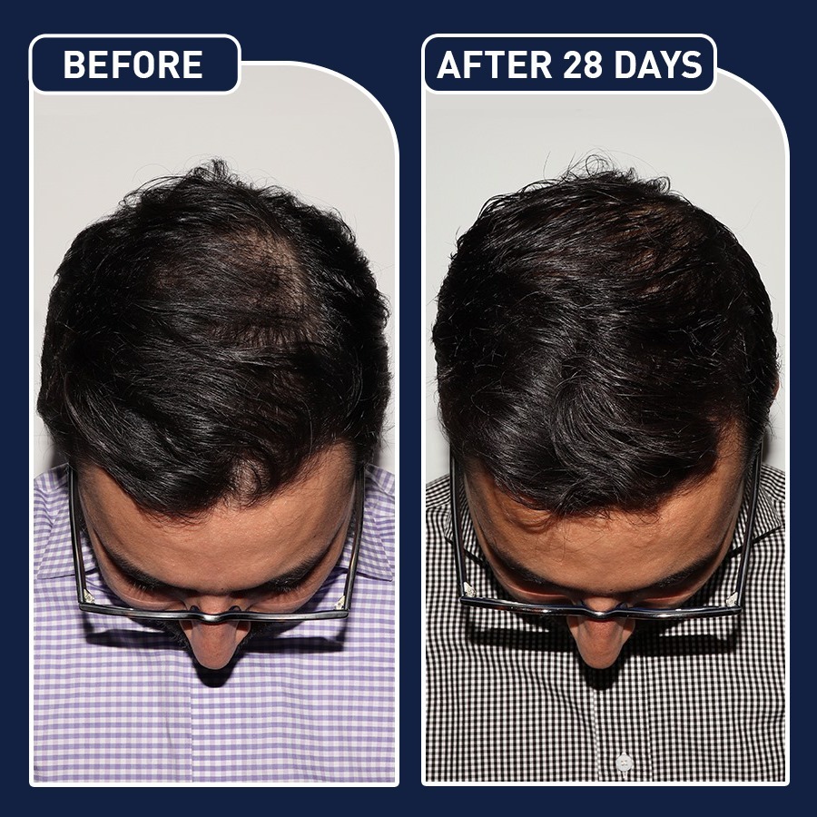FEG Hair Growth Spray - Image 5