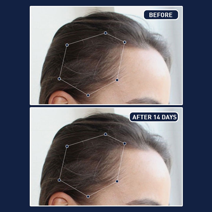 FEG Hair Growth Spray - Image 4