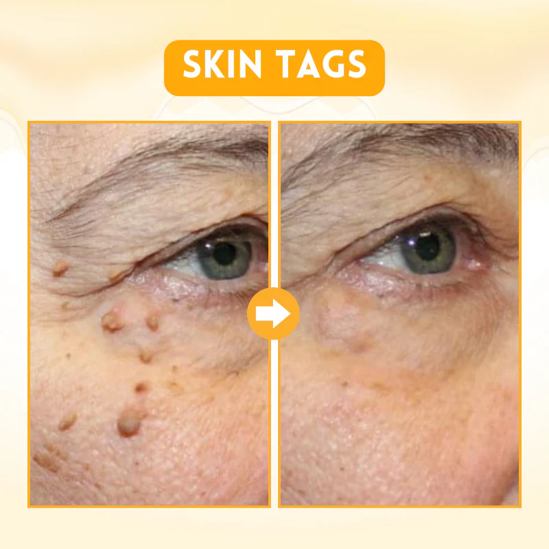 Bee Venom Multi-Action Ward Remover Cream - Image 4