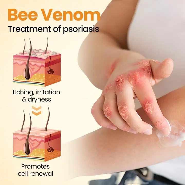 BeeLieve Psoriasis Skin Care - Image 2