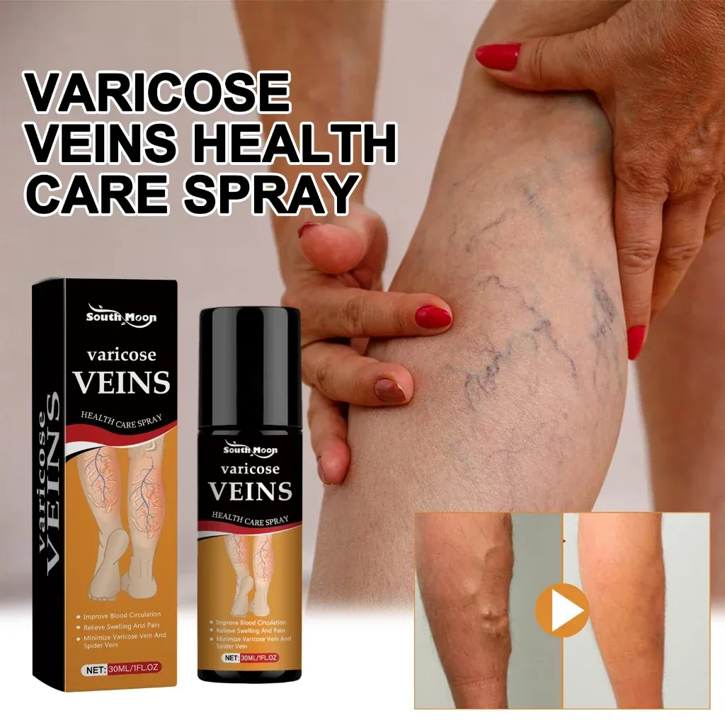 Varicose Vein Treatment Spray, Leg Varicose Vein Treatment - Image 4