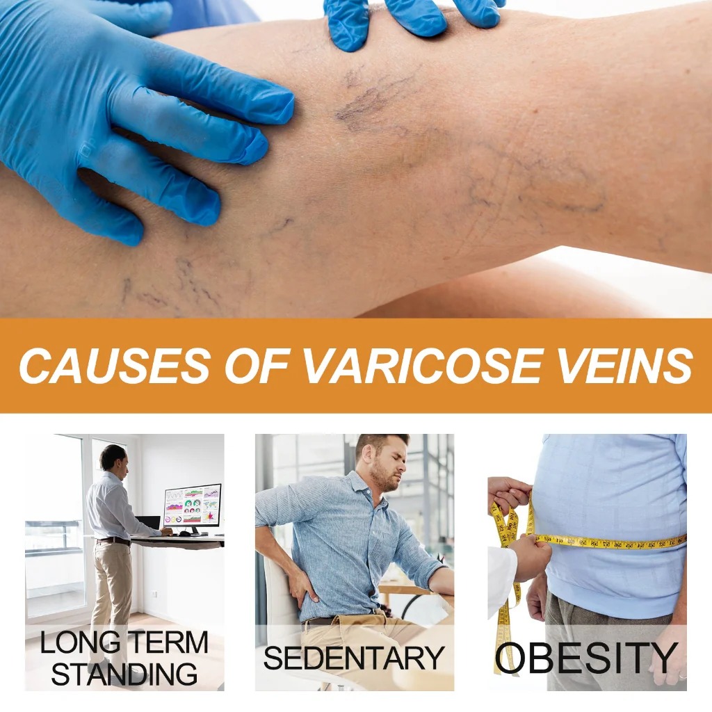 Varicose Vein Treatment Spray, Leg Varicose Vein Treatment - Image 6