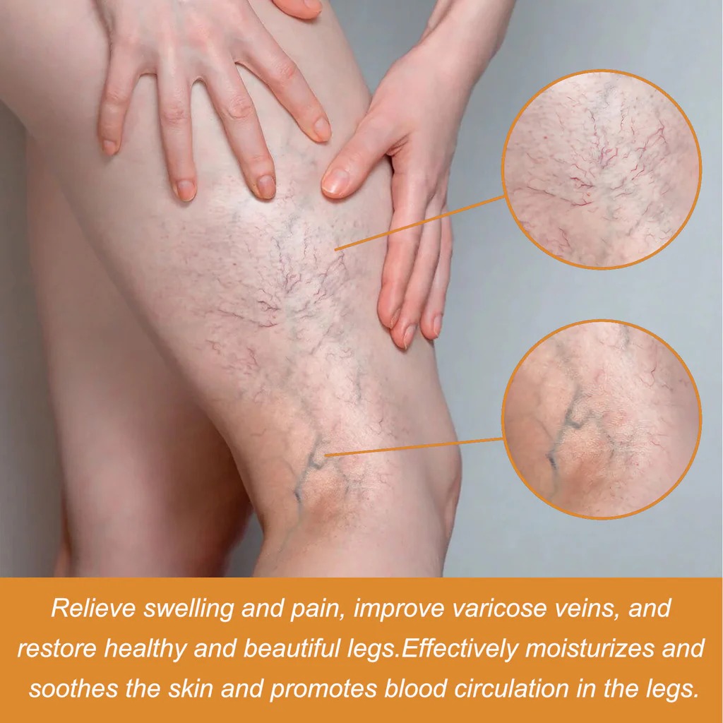 Varicose Vein Treatment Spray, Leg Varicose Vein Treatment - Image 7