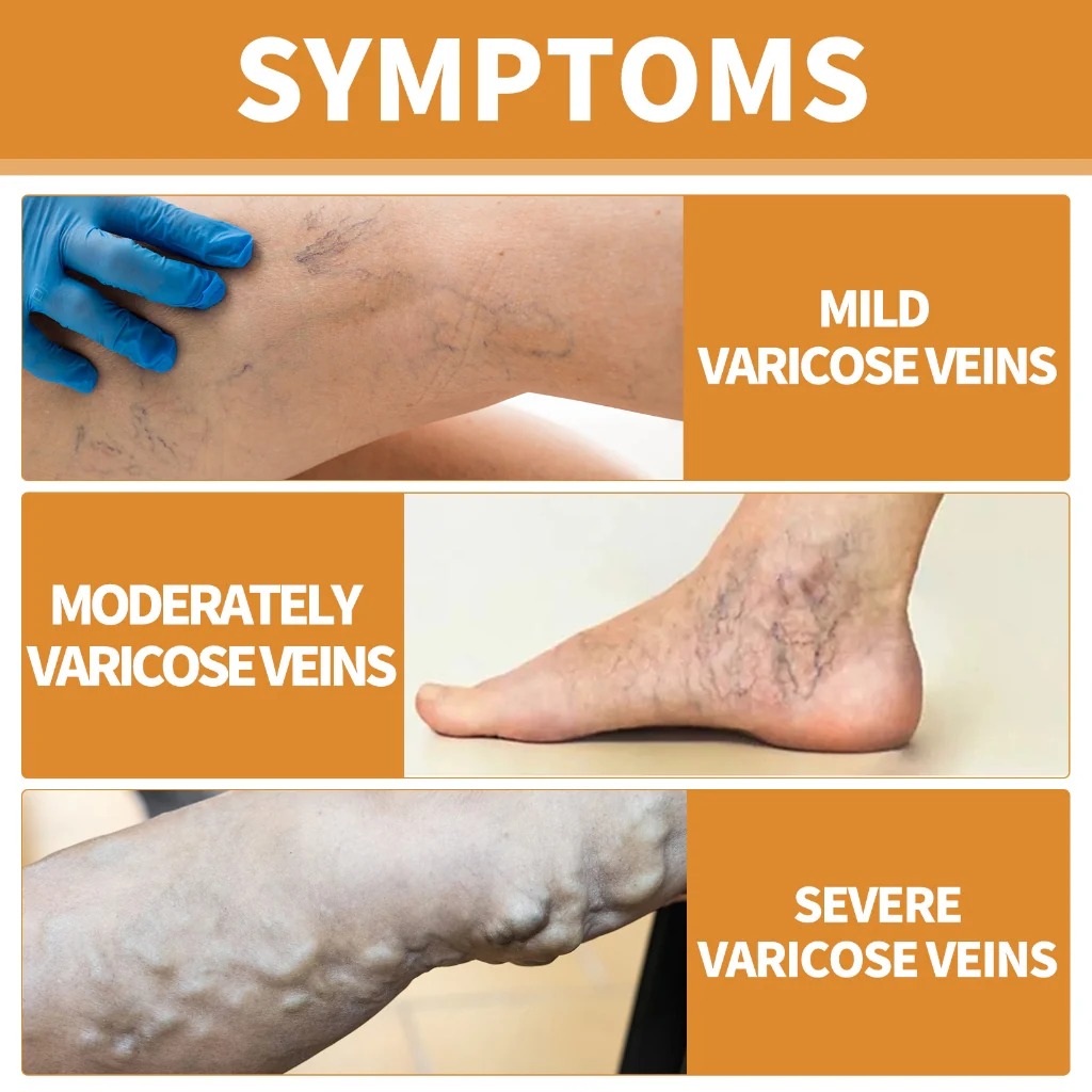 Varicose Vein Treatment Spray, Leg Varicose Vein Treatment - Image 3