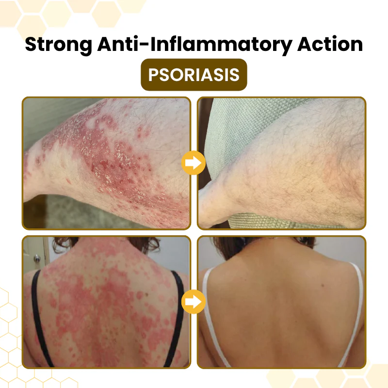 PsoriaSoothe Skin-Restoration Cream - Image 2