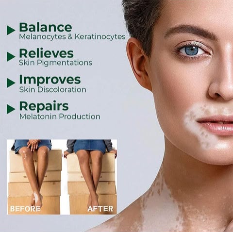 Vitiligo Herbal Aloe Vera & Mint Care Cream - Image 2