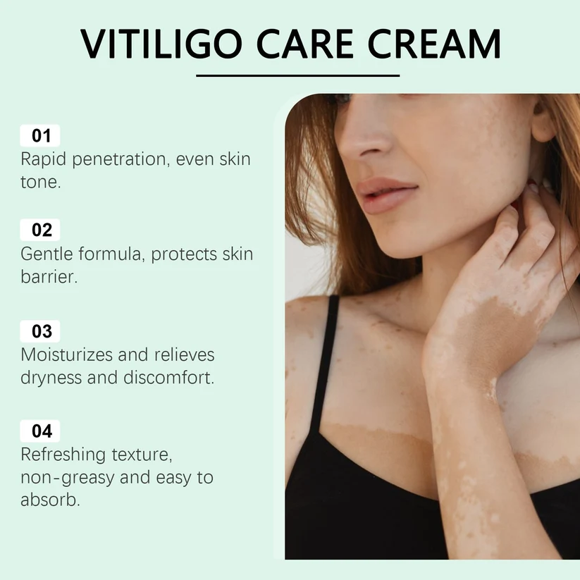 Vitiligo Herbal Aloe Vera & Mint Care Cream - Image 4