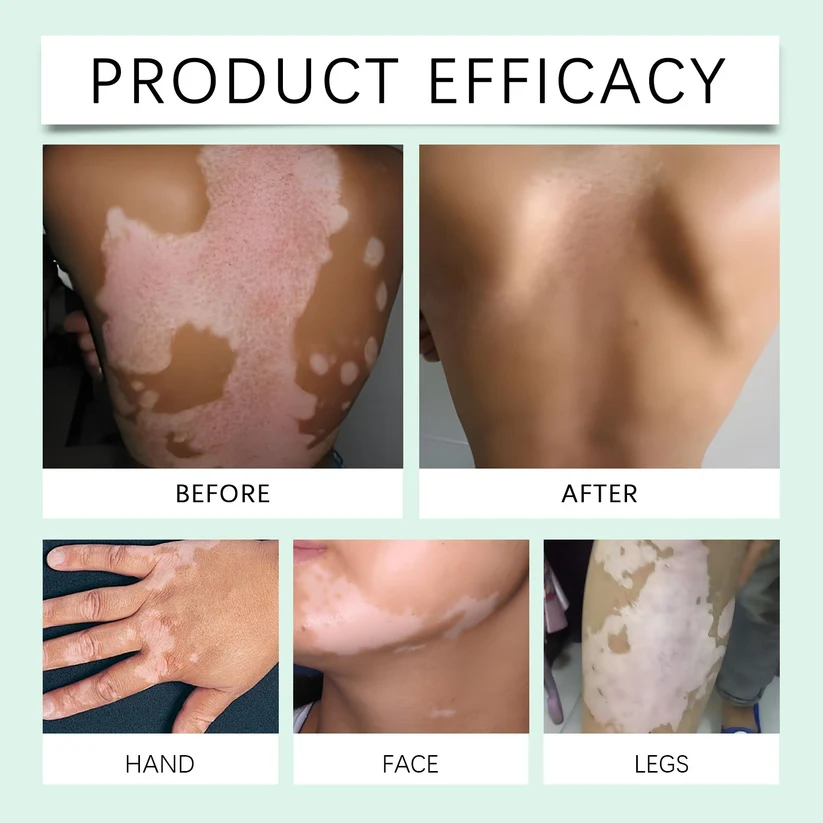Vitiligo Herbal Aloe Vera & Mint Care Cream - Image 3