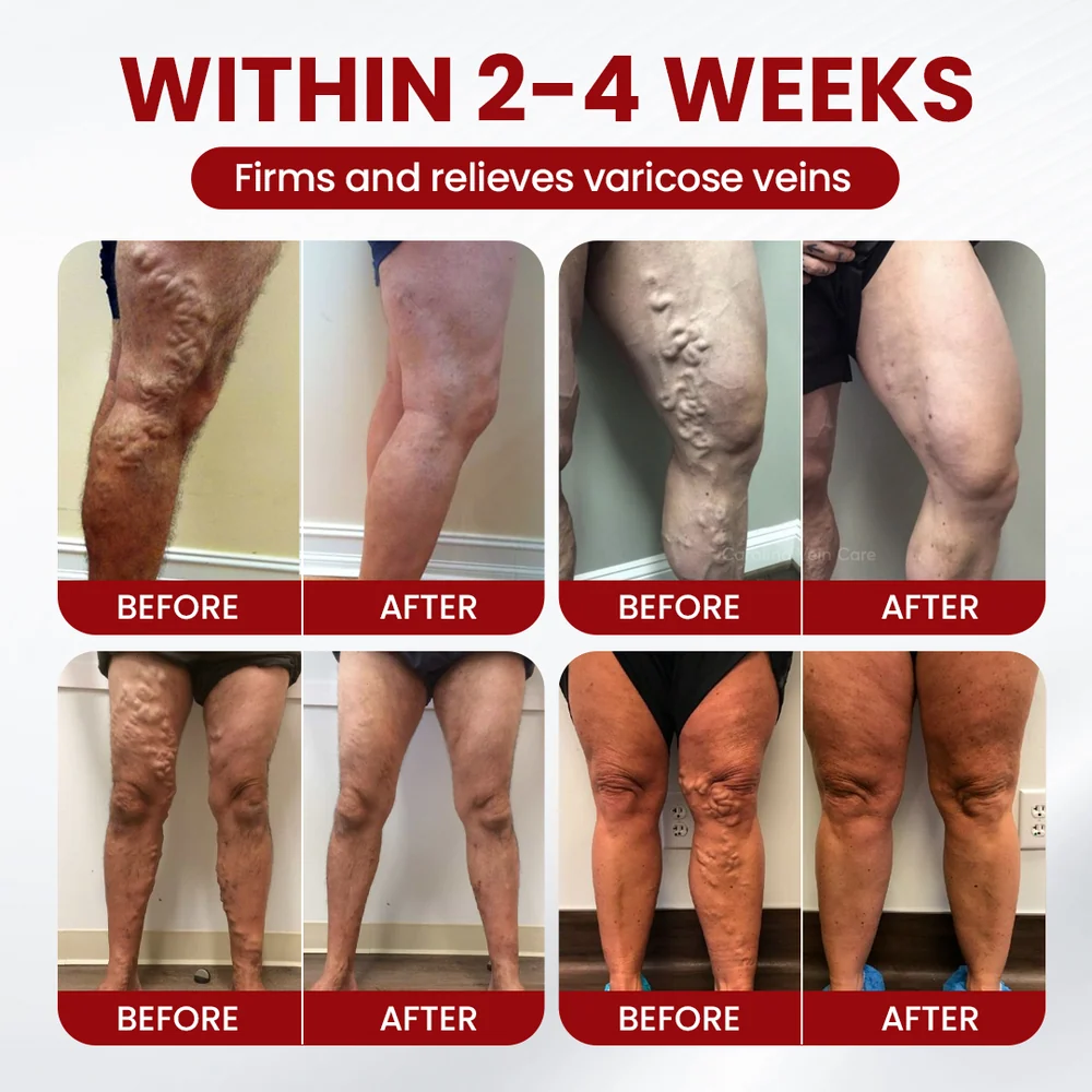 Get Rid of Varicose & Spider Veins. Show Your Legs Again. - Image 5