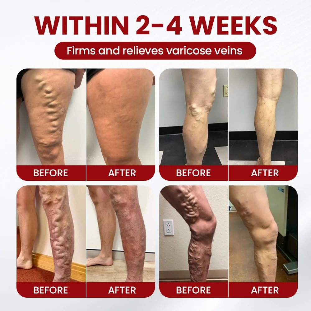 Get Rid of Varicose & Spider Veins. Show Your Legs Again. - Image 4